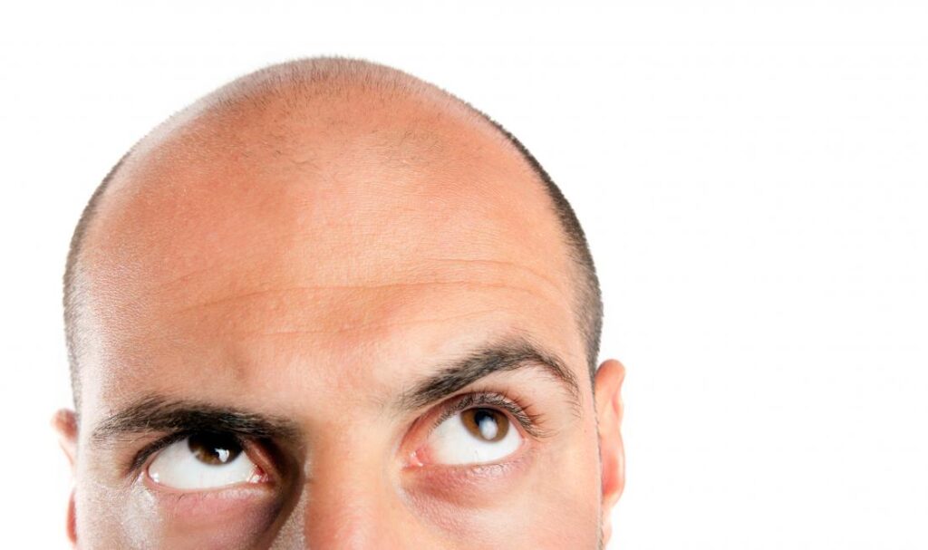 Misconception About Baldness