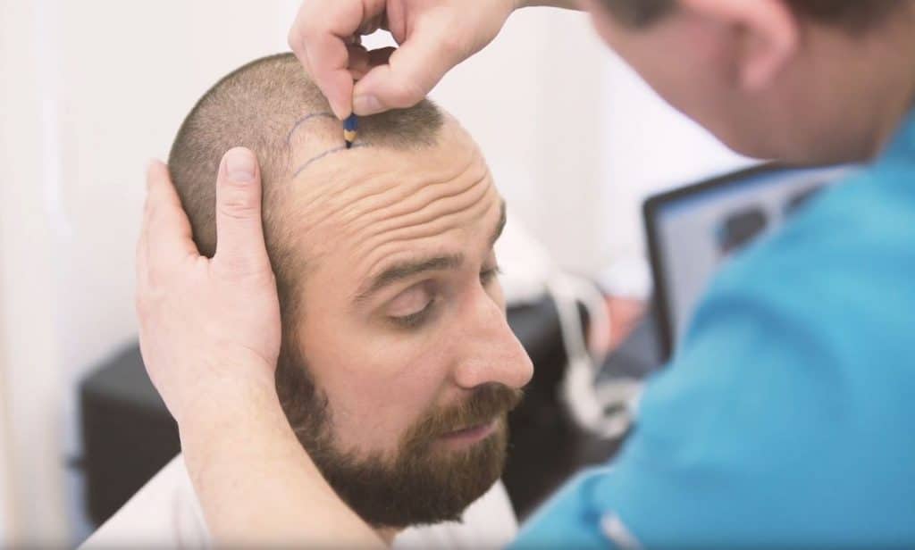 HAIR TRANSPLANT DISORDERS: WHAT TO EXPECT