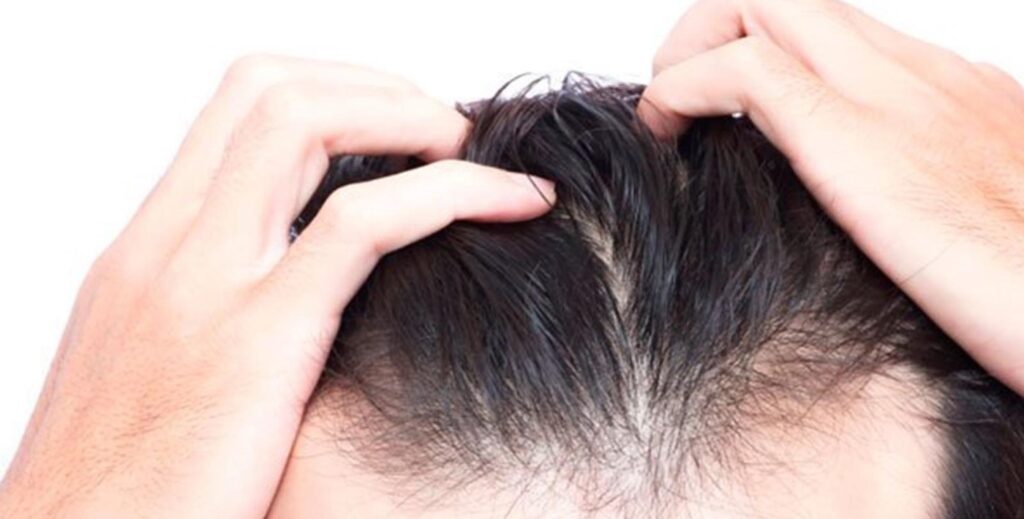HAIR TRANSPLANT IN YOUNG PEOPLE: WHAT IS THE IDEAL AGE?