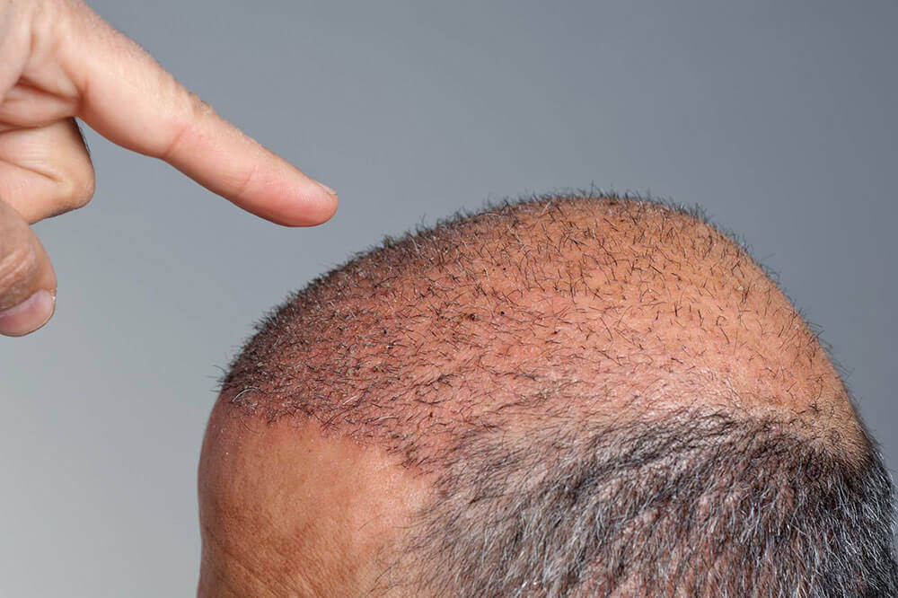 IS THERE A RISK OF SCARRING IN HAIR TRANSPLANTATION?